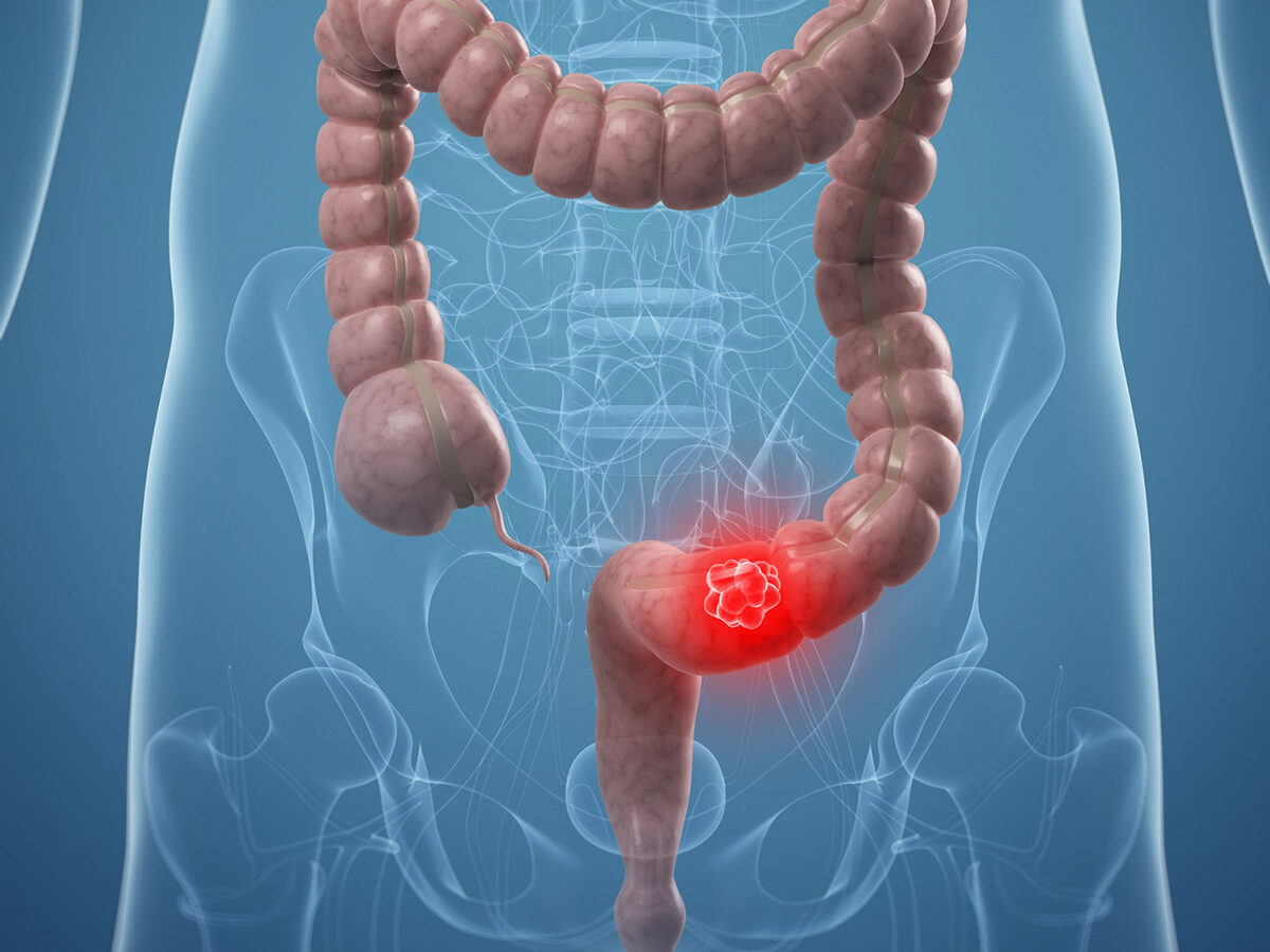 Cancro do cólon é silencioso, indistinto e fácil de confundir. Como se  deteta e trata um dos cancros que mais matam em Portugal - CNN Portugal